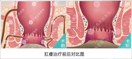 肛瘘有哪几种治疗方法