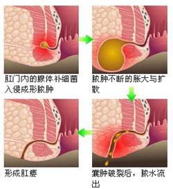 福州医博肛肠医院肛肠科诊疗中心拥有强大的医生团队和先进的医疗设备，如您有痔疮，肛裂，腹泻，便秘，肛瘘等肛肠疾病，请您及时就医，尽快治疗。我院秉承、创口微小、好得快的理念，运用中医特色治疗结合国际前沿医博方法，针对性治疗不同类型的肛肠疾病。治效果果均达到国际先进水平，方法超越同行，就医环境优雅，服务周到。网上预约无需排队，依据国家标准收费。为众多患者了除烦恼。我院24小时咨询热线0591-88032199，医院地址：福州市仓山区则徐大道318号（三叉街新村站附近）。